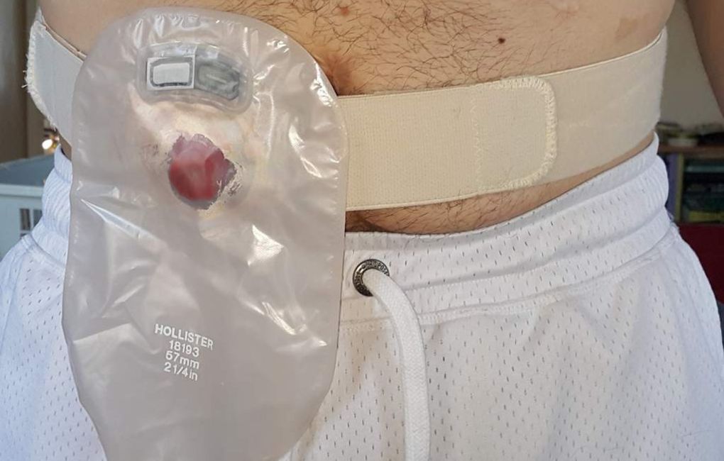 How does a colostomy bag work