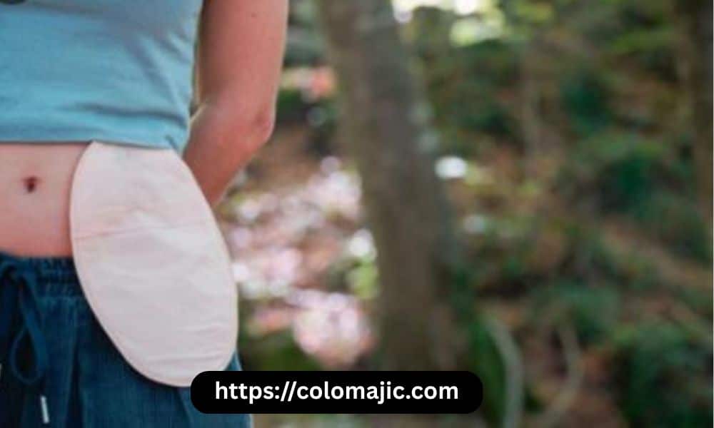 Managing Your Budget with Affordable Ostomy Supplies Without Sacrificing Quality